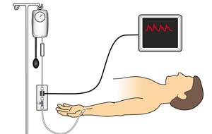 Мониторинг инвазивного артериального давления: практические аспекты
