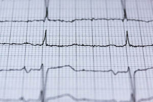 Современные подходы к лечению кардиогенного шока
