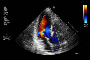 УЗИ сердца (эхокардиография) в условиях пандемии COVID-19